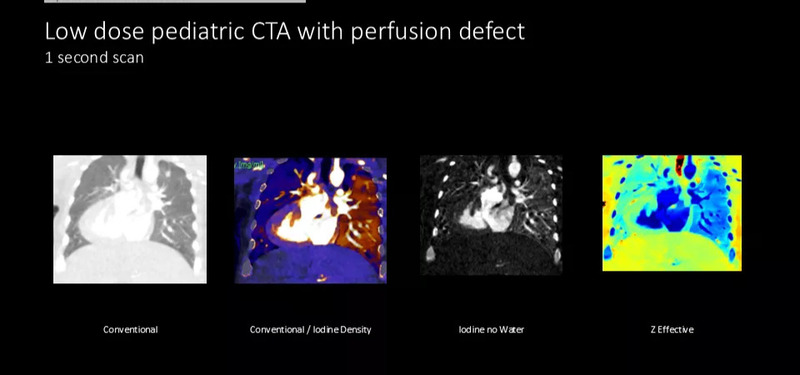 Система компьютерной томографии Philips Spectral CT 7500